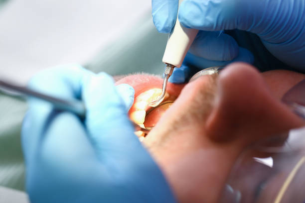 Best Emergency Wisdom Tooth Extraction in Bidwell, OH